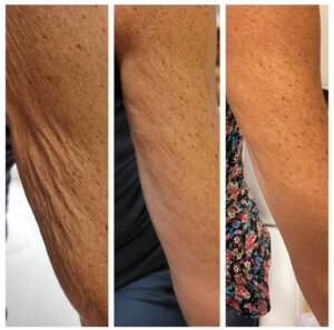 Three photos of bare arms side by side starting from wrinkled and eventually to smooth showcasing results of collagen therapy