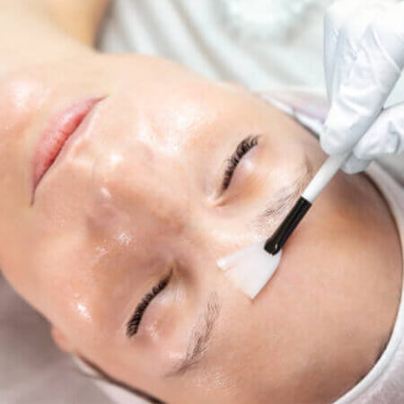 Facial Peels