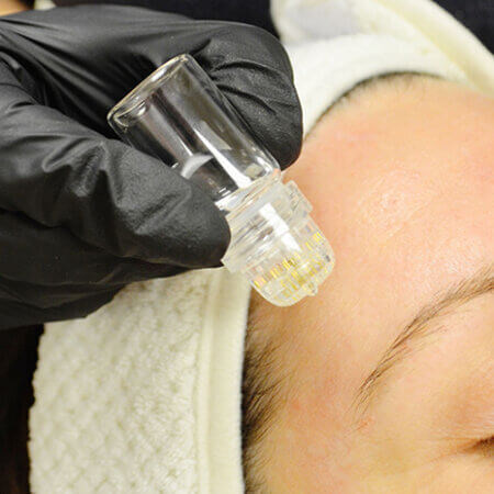 MesoGold20 Microinfusion Facial